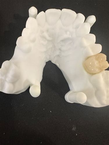 Coroa de zircónio sobre modelo dentário